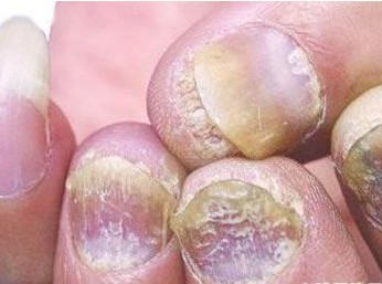 南昌治疗灰指甲最好的医院