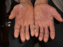 手部湿疹
