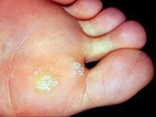 特殊寻常疣——跖疣