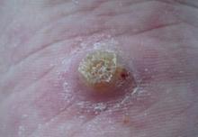 寻常疣危害知识普及