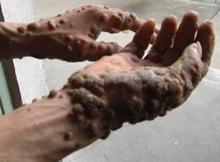 寻常疣拖延不治危害严重