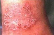 体癣是怎么形成的