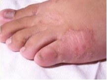 手足癣
