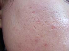 青春痘痤疮的正确预防要点