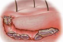 疥疮发生后的皮肤损害