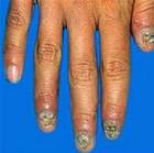 近端甲下型灰指甲