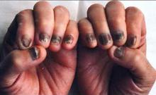 全甲营养不良型灰指甲