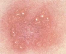 扁平疣的症状表现有哪些