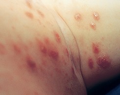 Ïêϸ½â˵½ê´¯Ö¢×´Í¼Æ¬