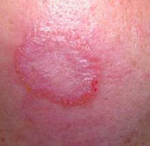 ÌåÑ¢µÄÔçÆÚÖ¢×´±íÏÖ