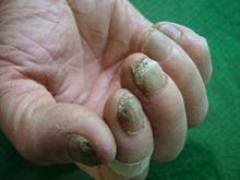 灰指甲症状图片