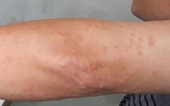 点滴型副银屑病