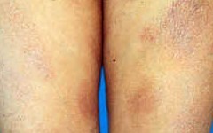 苔藓样型副银屑病