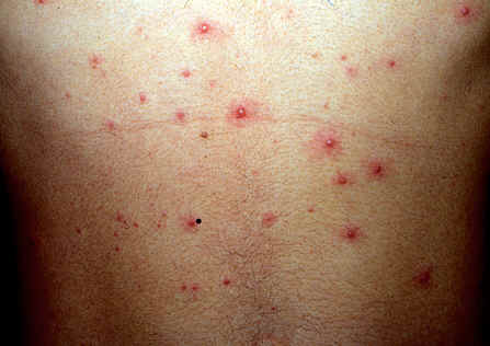 带状疱疹初期图片