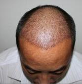 解析脂溢性脱发图片