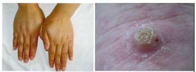 寻常疣症状图片