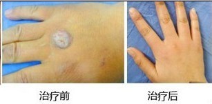 寻常疣的治疗图片
