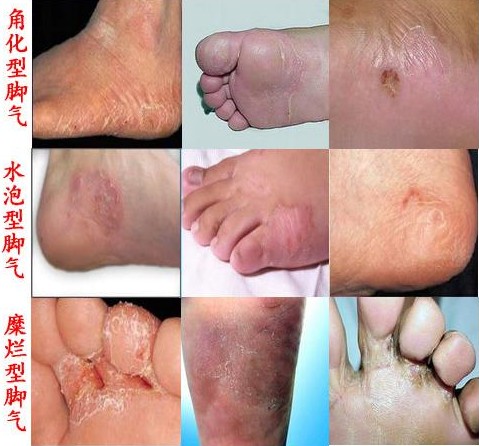 手足癣图片