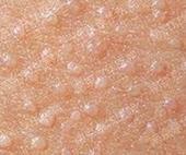 面部扁平疣症状表现