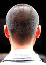 专家解析脂溢性脱发图片