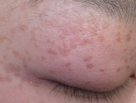 眼部扁平疣图片