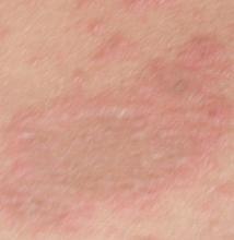 ÂýÐÔʪÕîÖ¢×´±íÏÖ