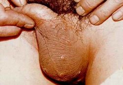 解析阴囊疥疮图片