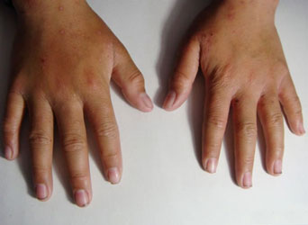 疥疮的初期症状是怎样