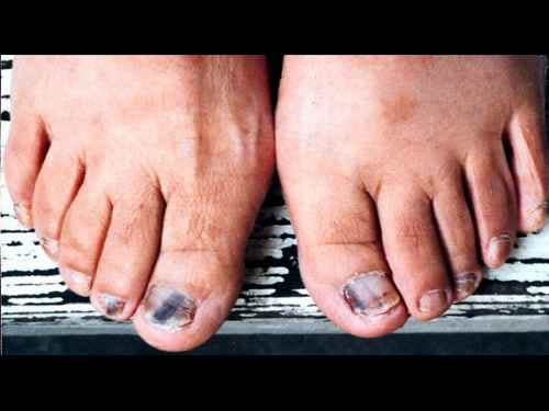 灰指甲的初期图片