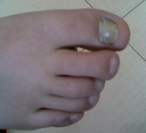 灰指甲最初期症状图片