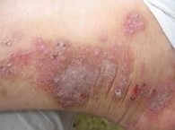 ¼±ÐÔʪÕîµÄͼƬ