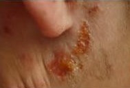 ÑǼ±ÐÔʪÕîµÄͼƬ