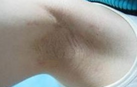 导致狐臭产生原因