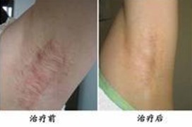 腋臭的治疗方法