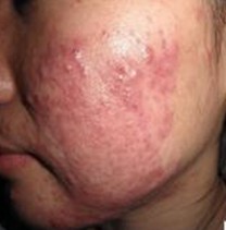 青春痘的产生主要与五脏六腑关系密切