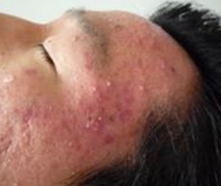 顽固性青春痘产生的原因