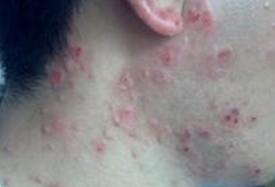 脖子上长痘痘是什么原因?