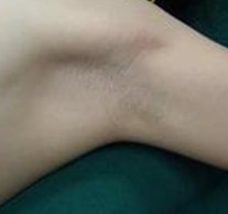 南昌中山皮肤病医院治疗腋臭