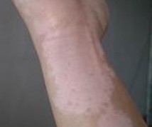 神经性白癜风的发病论