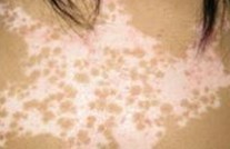 白癜风扩散时的表现症状都有哪些?