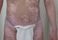 白癜风患者会产生哪些不良情绪?