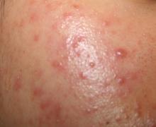 ҩ��������ı׶�