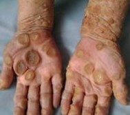 寻常疣的症状表现