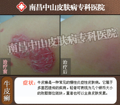 牛皮癣特征性皮损症状有哪些