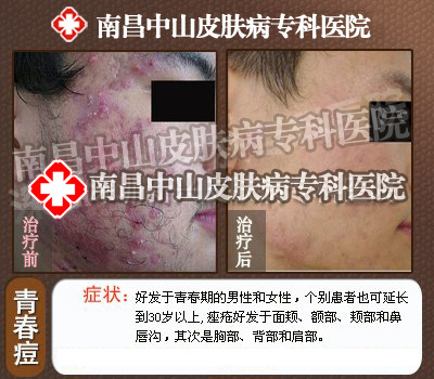 痤疮