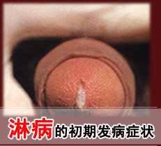 淋病的初期发病症状