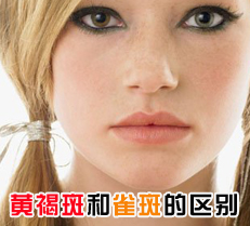 黄褐斑和雀斑的区别