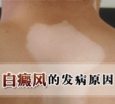 白癜风的发病原因
