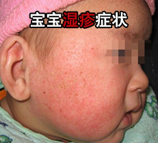 宝宝湿疹图片