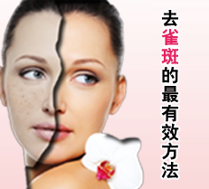 去雀斑的最有效方法